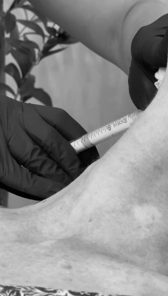 An injectable treatment in progress at Noir Medical Aesthetics